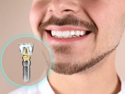 Depositphotos_624075360_XL Man with beautiful smile after dental implant installation procedure on beige background, closeup